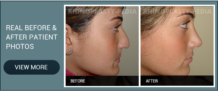 rhinoplasty combined with chin implant female before and after patient photo