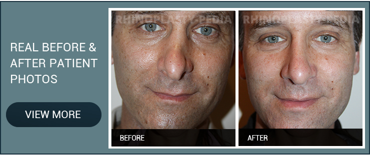 rhinoplasty combined with facelift male before and after patient photo