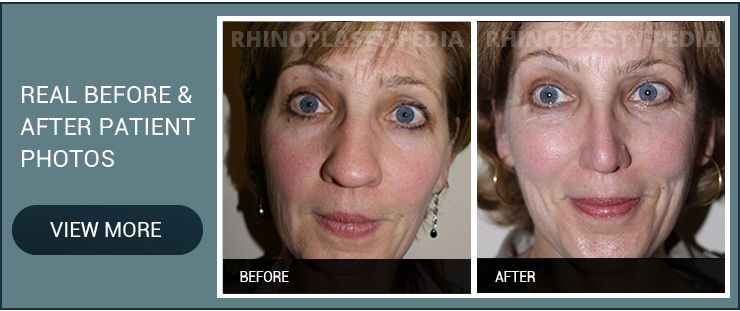 rhinoplasty combined with Laser for Winkles and skin tightening before and after female patient photo