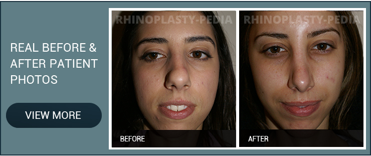 rhinoplasty combined with Septoplasty female patient before and after photo