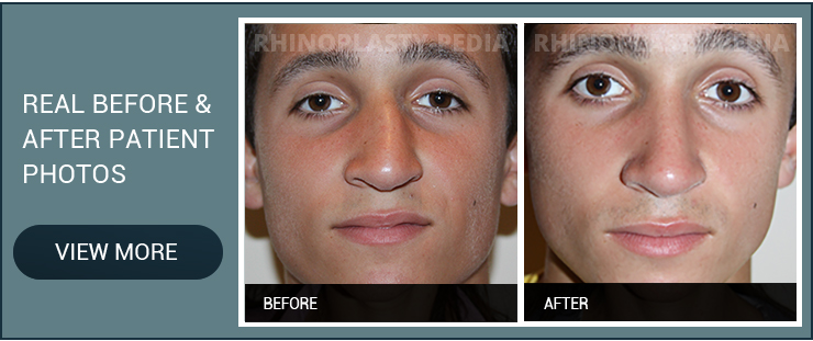 rhinoplasty combined with sinus surgery male patient before and after photo