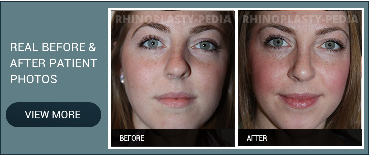 caucasian rhinoplasty female patient before and after photo