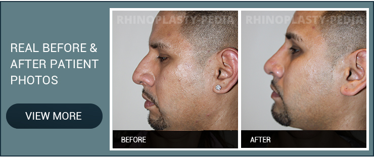 latino and hispanic rhinoplasty male patient before and after photo