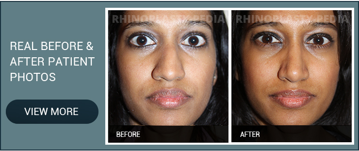 middle eastern and mediterranean rhinoplasty before and after patient photo banner