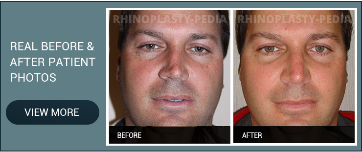 revision rhinoplasty consultation male patient real before and after photo
