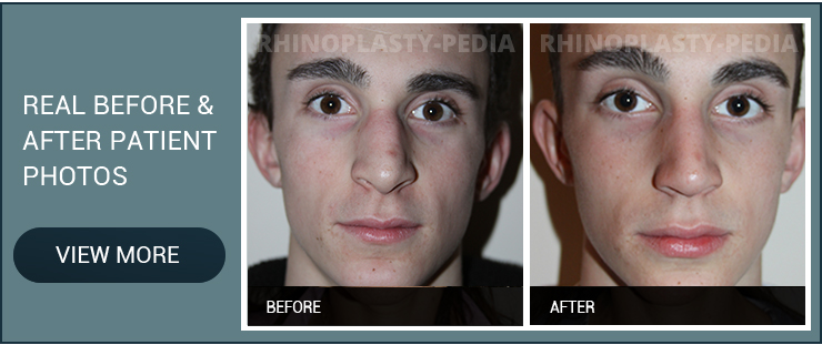 revision rhinoplasty surgeons male patient before and after photo