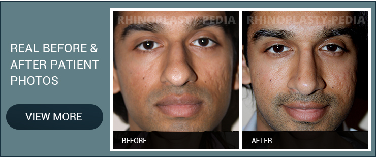 finding a septal perforation surgeon male patient before and after photo