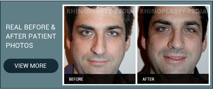 causes of septal perforation male patient before and after photo