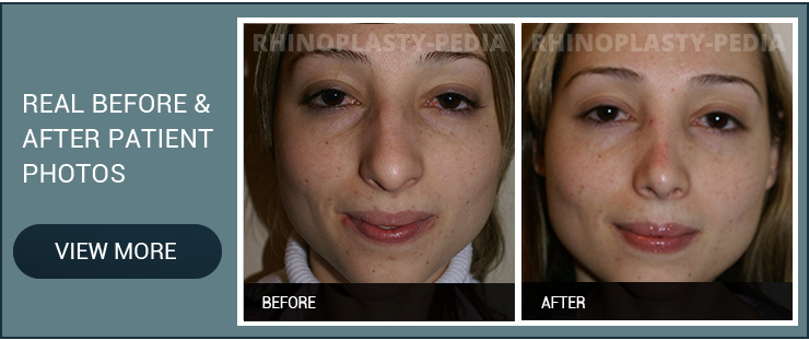 rhinoplasty recovery female patient before and after photo