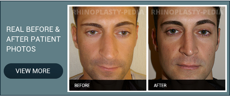 sinus surgery real before and after male patient photo