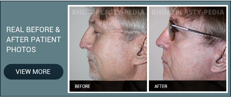 sinus surgery recovery before and after male patient photo