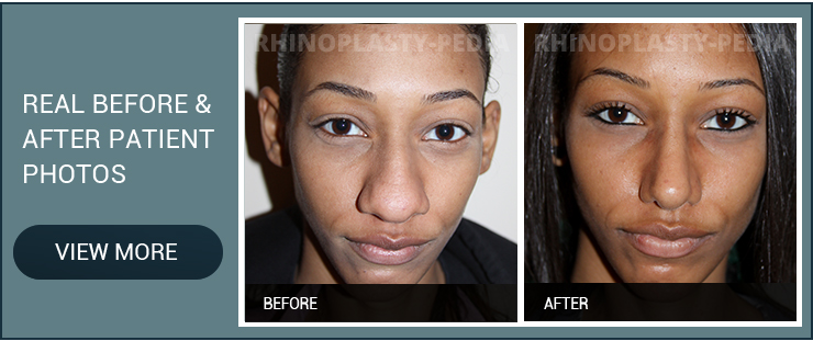 rhinoplasty complications female patient before and after photo