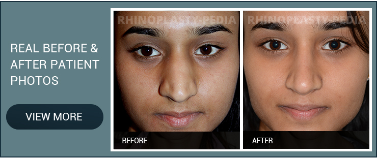 guide to ethnic rhinoplasty female patient before and after photo