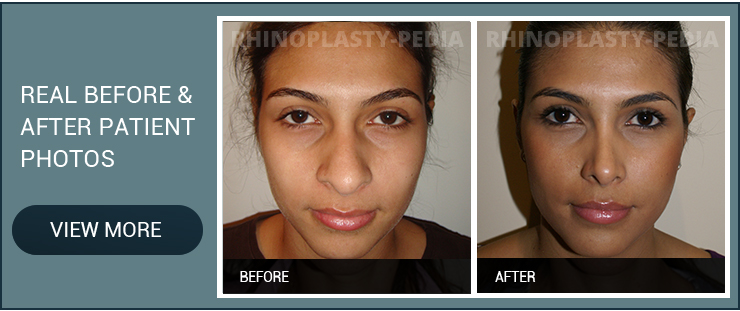 female rhinoplasty patient before and after photo