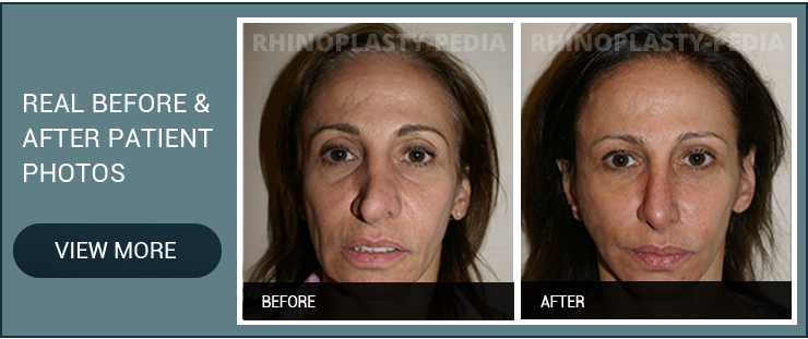 best rhinoplasty surgeon patient before and after photo banner