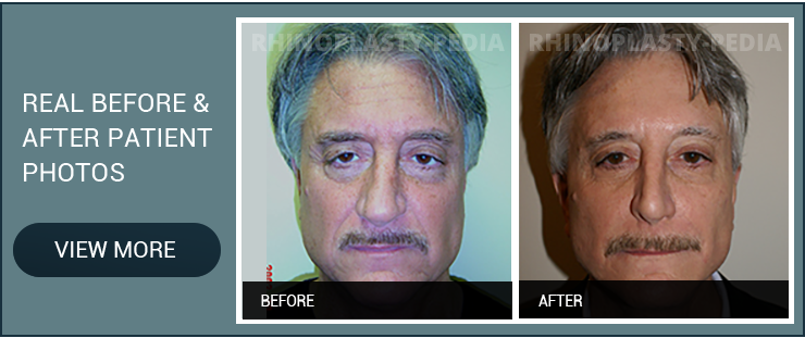 rhinoplasty surgeon Dr. Sam Rizk patient before and after photo banner