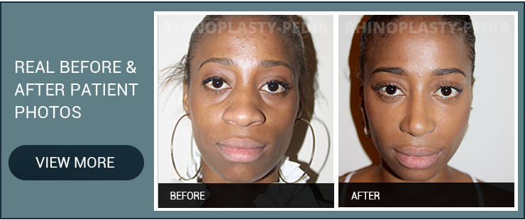 african american rhinoplasty patient before after photo banner