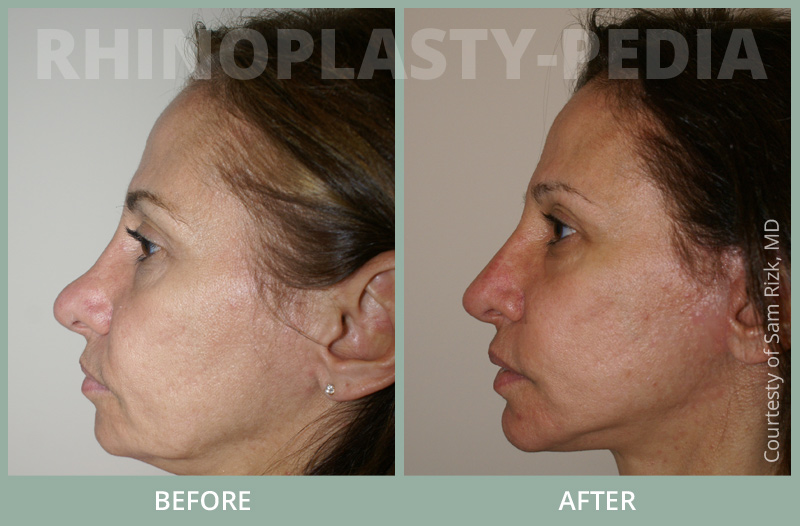 rhinoplasty female patient before and after photo 1