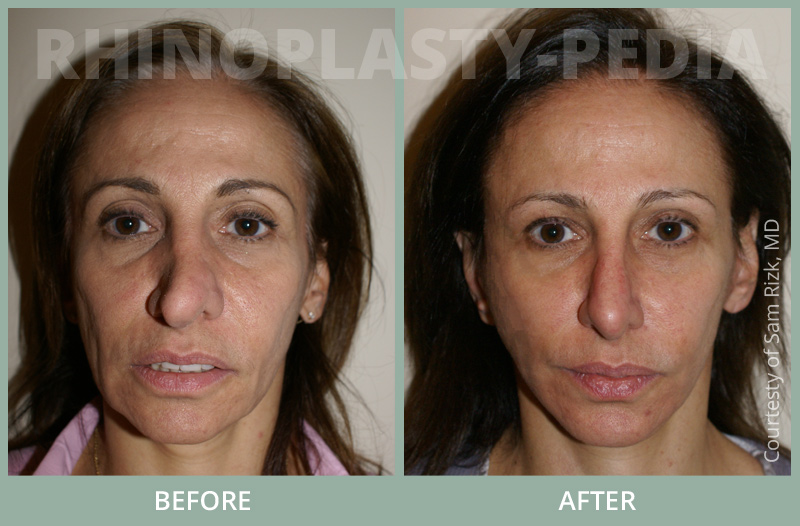 female rhinoplasty patient before and after photo 2