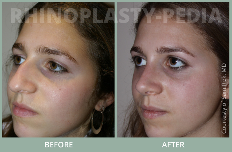 rhinoplasty female patient before and after photo set 65