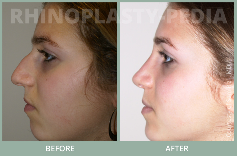 rhinoplasty female patient before and after photo set 67