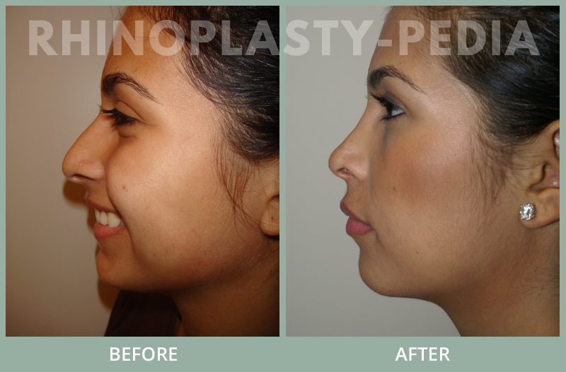 rhinoplasty female patient before and after photo set 20