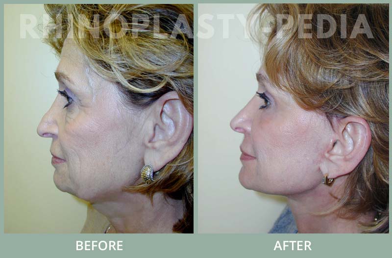 rhinoplasty female patient before and after photo set 81