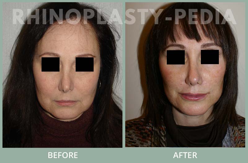 female rhinoplasty patient before and after photo 14