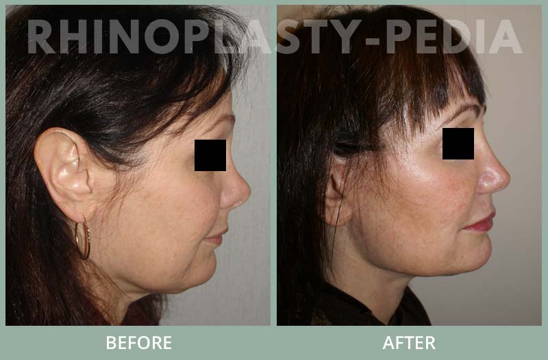 rhinoplasty female patient before and after photo set 83