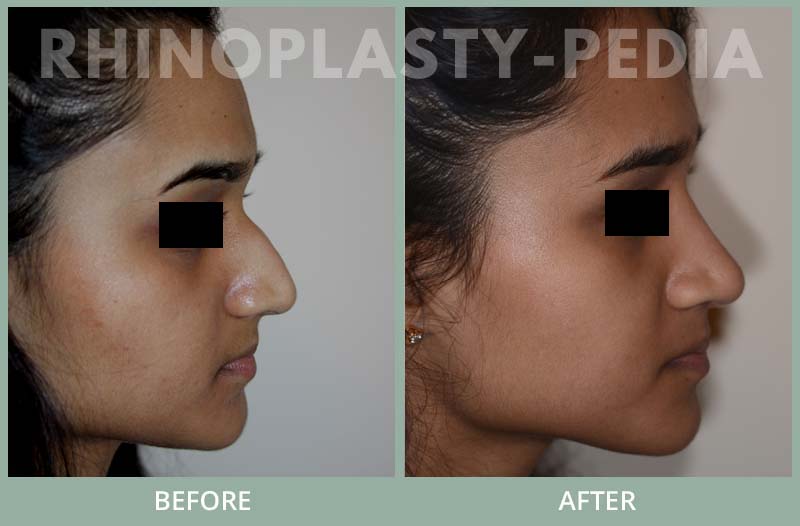 rhinoplasty female patient before and after photo set 89