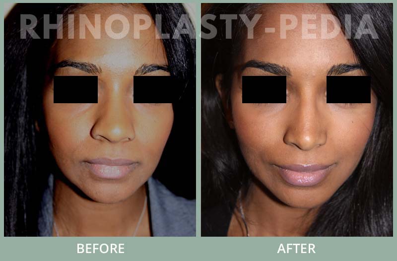 rhinoplasty female patient before and after photo set 10