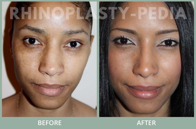 rhinoplasty female patient before and after photo set 90