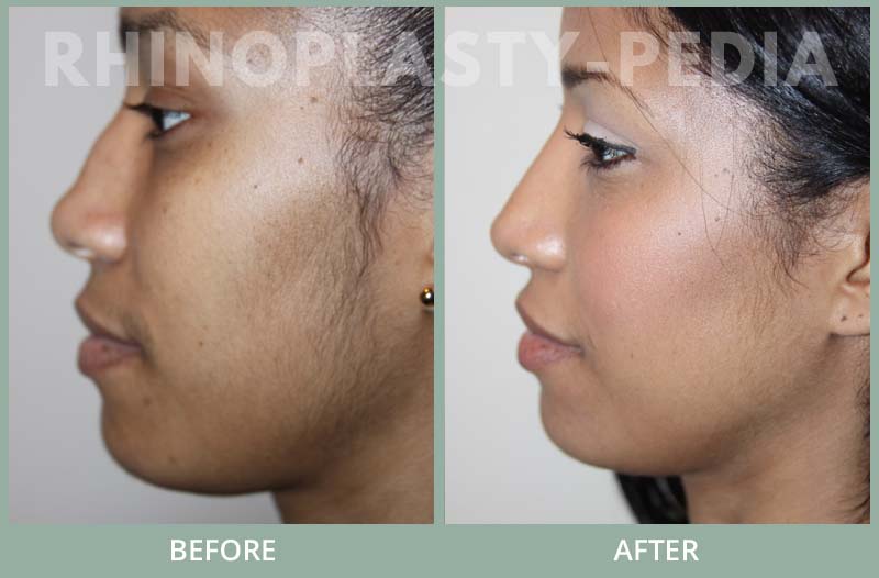 rhinoplasty female patient before and after photo set 91