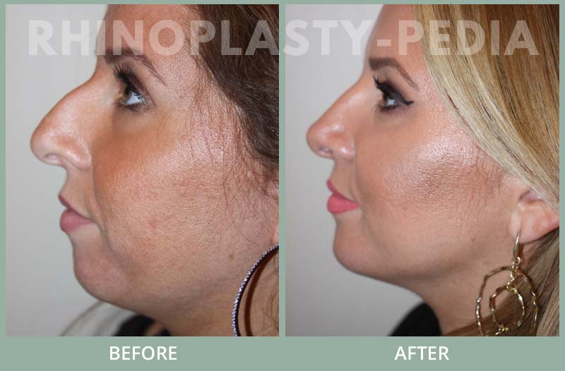 rhinoplasty female patient before and after photo set 95