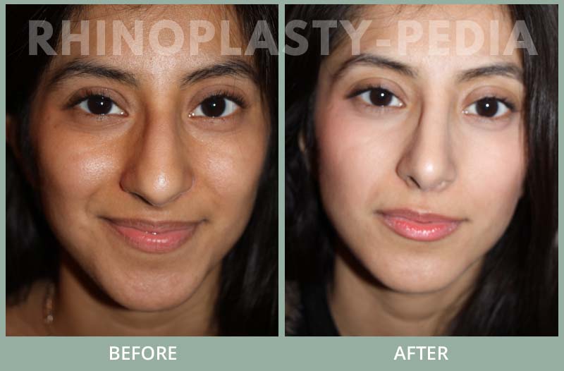 rhinoplasty female patient before and after photo set 96
