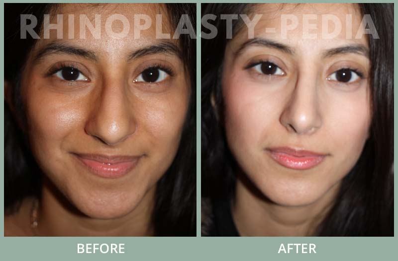 female rhinoplasty patient before and after photo 32