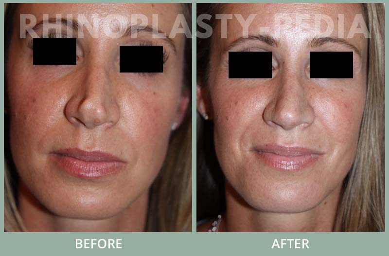 female rhinoplasty patient before and after photo 33