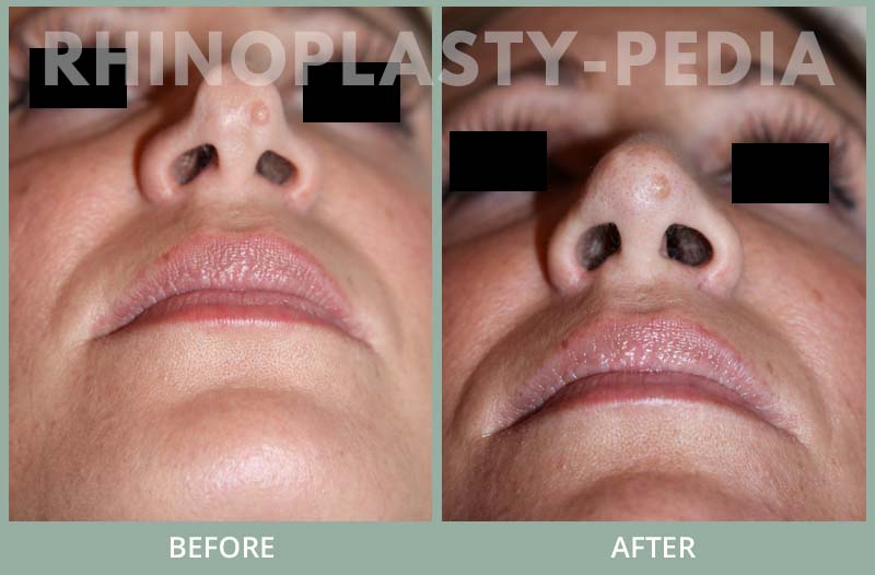 rhinoplasty female patient before and after photo set 99