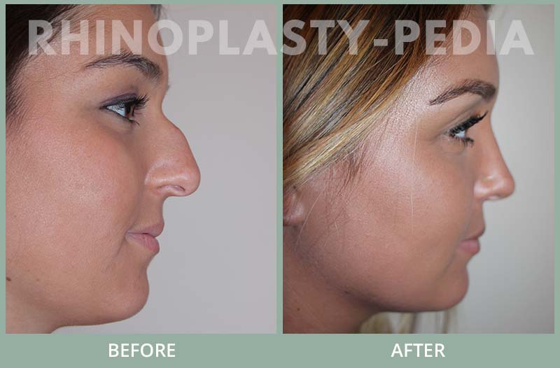 rhinoplasty female patient before and after photo set 101