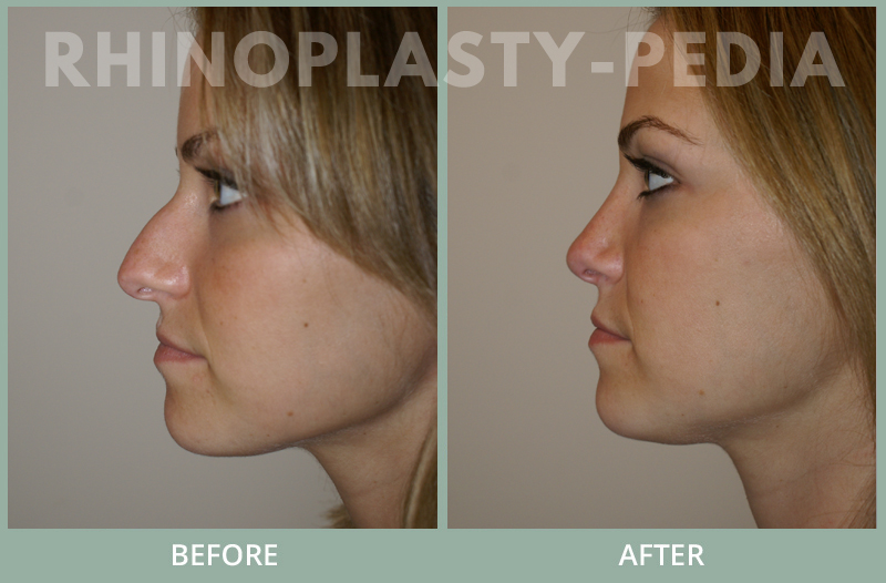 rhinoplasty female patient before and after photo set 103