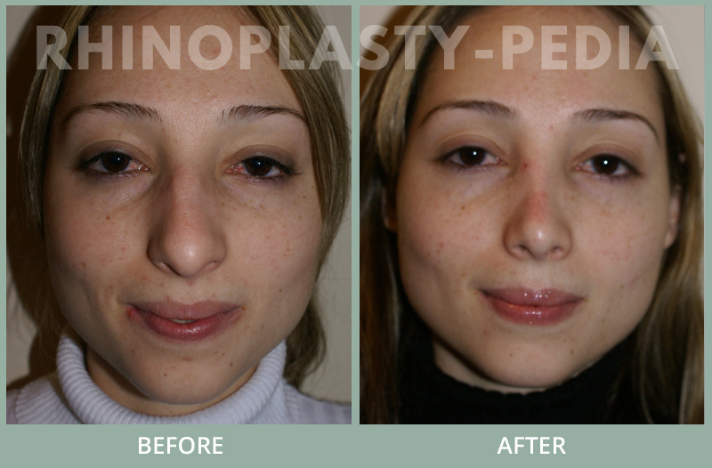 female rhinoplasty patient before and after photo 16