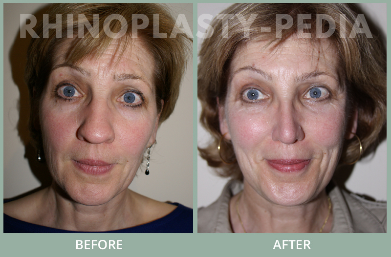 rhinoplasty female patient before and after photo 40