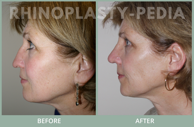 rhinoplasty female patient before and after photo set 106
