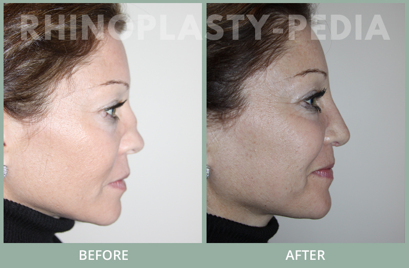 rhinoplasty female patient before and after photo set 108