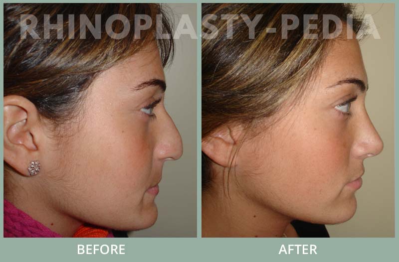 rhinoplasty female patient before and after photo set 111