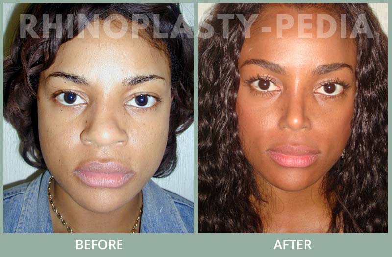 rhinoplasty female patient before and after photo set 112