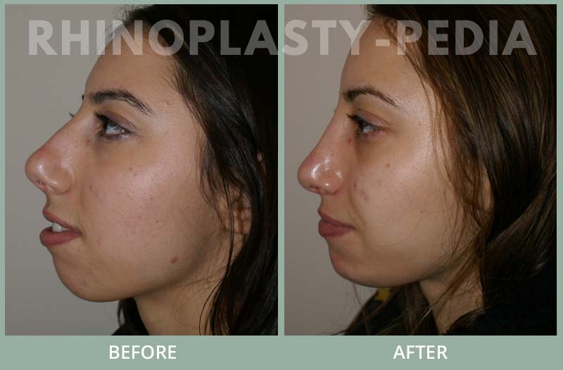 female rhinoplasty patient before and after photo 18