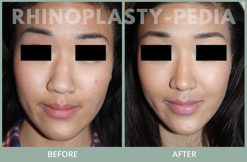female paient before and after rhinoplasty set 1 side view