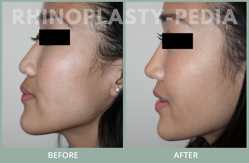 female paient before and after rhinoplasty set 1 side view