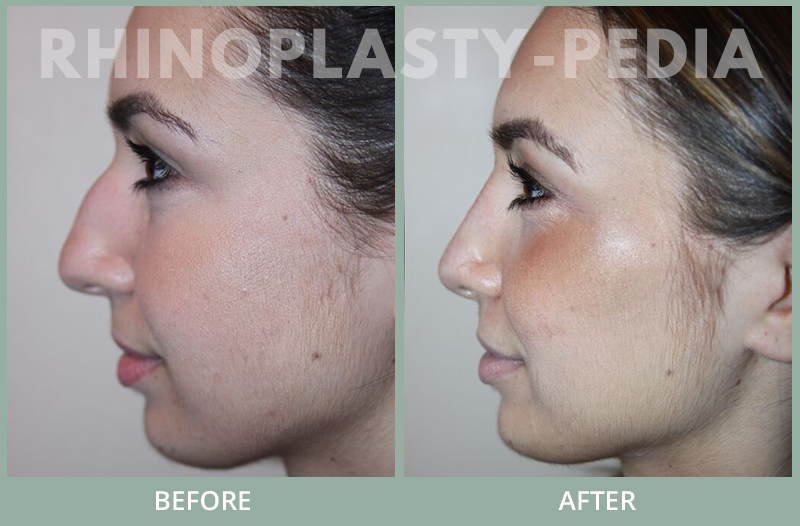 female rhinoplasty patient before and after photo 35